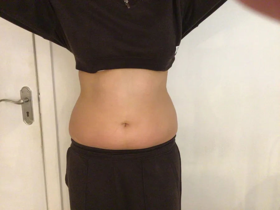 After body contouring at Laserlite Aesthetic Clinic, front view After body contouring at Laserlite Aesthetic Clinic, front view