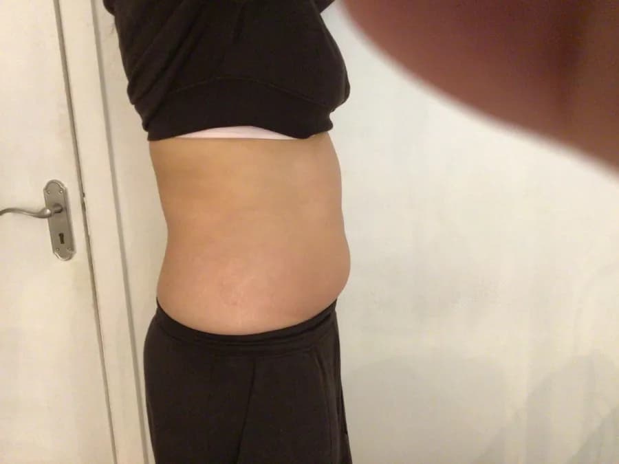 After body contouring at Laserlite Aesthetic Clinic, side view After body contouring at Laserlite Aesthetic Clinic, side view