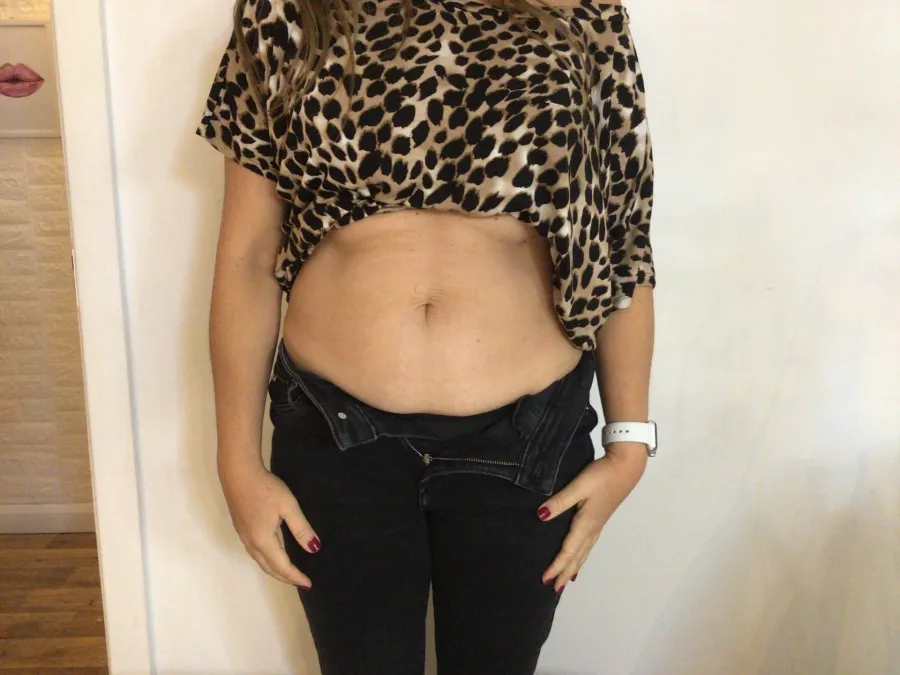 Before body contouring at Laserlite Aesthetic Clinic, front view Before body contouring at Laserlite Aesthetic Clinic, front view
