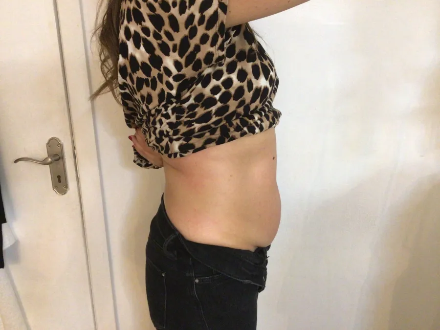 Before body contouring at Laserlite Aesthetic Clinic, side view Before body contouring at Laserlite Aesthetic Clinic, side view