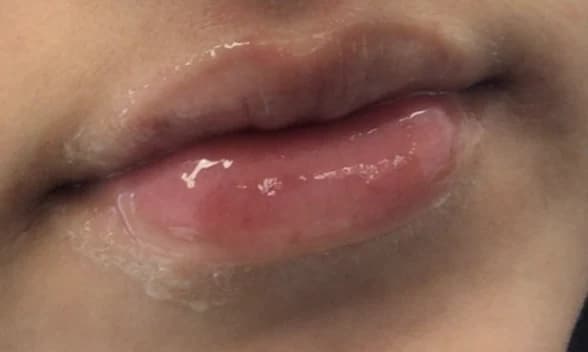 Lips after lip filler at Laserlite Aesthetic Clinic, close up Lips after lip filler at Laserlite Aesthetic Clinic, close up
