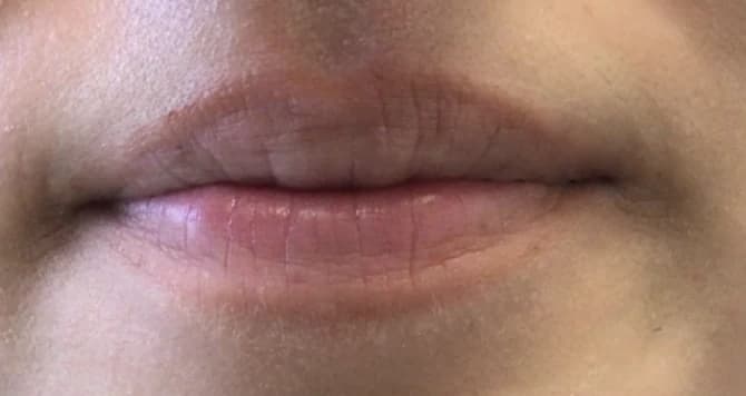 Lips before lip filler at Laserlite Aesthetic Clinic, close up Lips before lip filler at Laserlite Aesthetic Clinic, close up