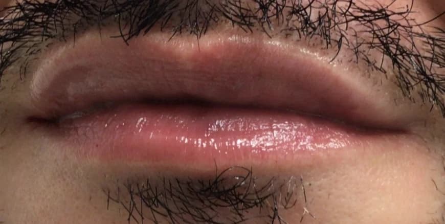 Lips after lip filler at Laserlite Aesthetic Clinic, a male patient Lips after lip filler at Laserlite Aesthetic Clinic, a male patient