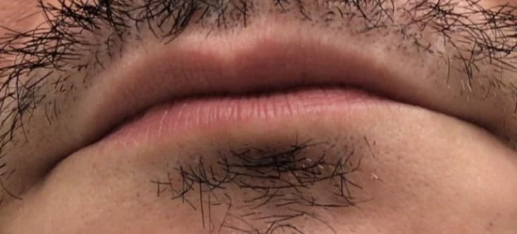 Lips before lip filler at Laserlite Aesthetic Clinic, a male patient Lips before lip filler at Laserlite Aesthetic Clinic, a male patient