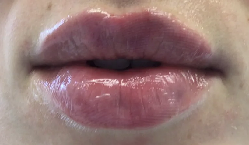 Lips after lip filler at Laserlite Aesthetic Clinic, front on Lips after lip filler at Laserlite Aesthetic Clinic, front on