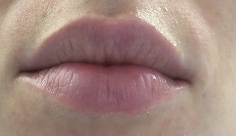 Lips before lip filler at Laserlite Aesthetic Clinic, front on Lips before lip filler at Laserlite Aesthetic Clinic, front on