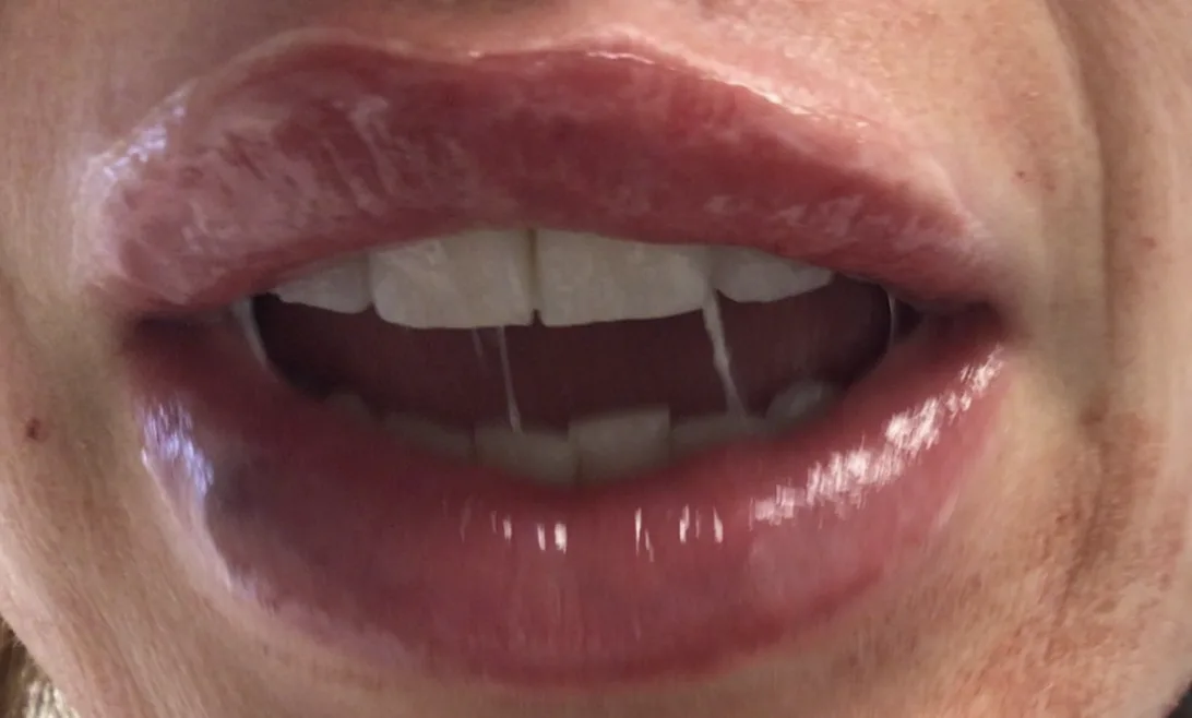 Lips after lip filler at Laserlite Aesthetic Clinic, smiling Lips after lip filler at Laserlite Aesthetic Clinic, smiling