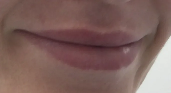 Lips before lip filler at Laserlite Aesthetic Clinic, from the side Lips before lip filler at Laserlite Aesthetic Clinic, from the side
