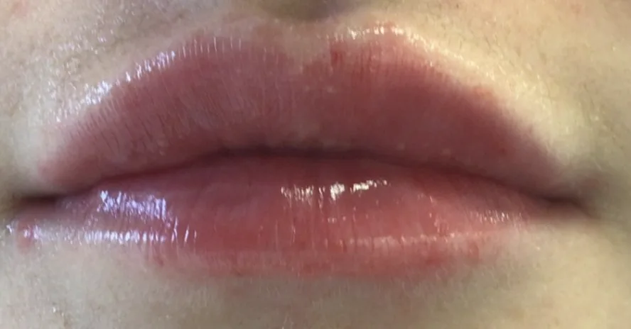 Lips after lip filler at Laserlite Aesthetic Clinic, resting Lips after lip filler at Laserlite Aesthetic Clinic, resting
