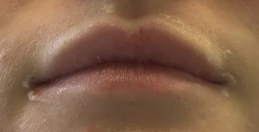 Lips before lip filler at Laserlite Aesthetic Clinic, resting Lips before lip filler at Laserlite Aesthetic Clinic, resting