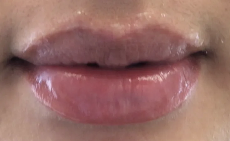Lips after lip filler at Laserlite Aesthetic Clinic, fuller and front on Lips after lip filler at Laserlite Aesthetic Clinic, fuller and front on