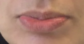 Lips before lip filler at Laserlite Aesthetic Clinic Lips before lip filler at Laserlite Aesthetic Clinic