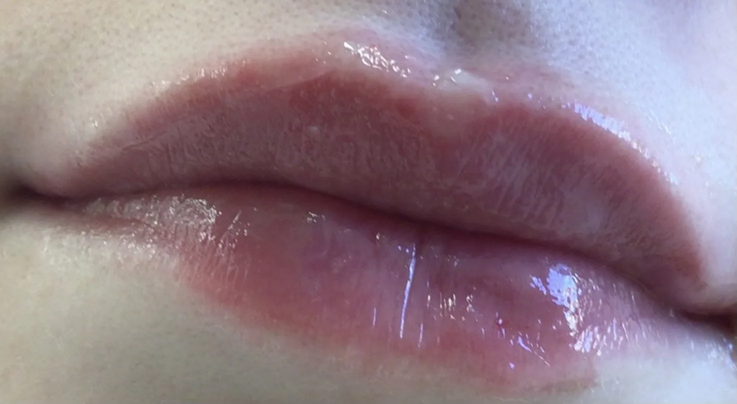 Lips after lip filler at Laserlite Aesthetic Clinic, close up and glossed Lips after lip filler at Laserlite Aesthetic Clinic, close up and glossed