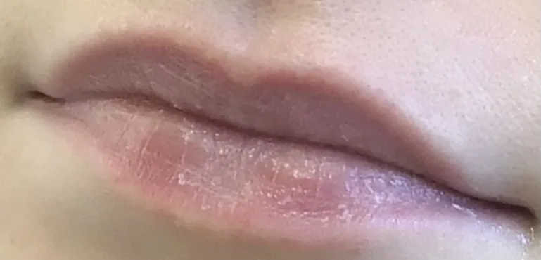 Lips before lip filler at Laserlite Aesthetic Clinic, close up Lips before lip filler at Laserlite Aesthetic Clinic, close up