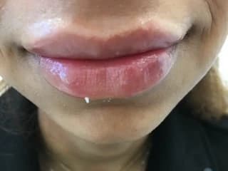 Lips after lip filler at Laserlite Aesthetic Clinic Lips after lip filler at Laserlite Aesthetic Clinic