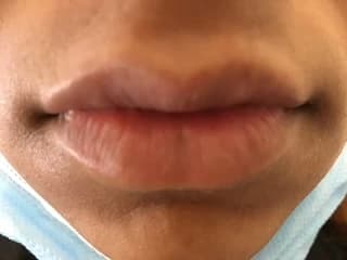 Lips before lip filler at Laserlite Aesthetic Clinic Lips before lip filler at Laserlite Aesthetic Clinic