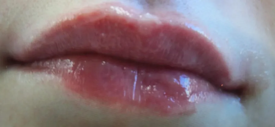 Lips after lip filler at Laserlite Aesthetic Clinic Lips after lip filler at Laserlite Aesthetic Clinic