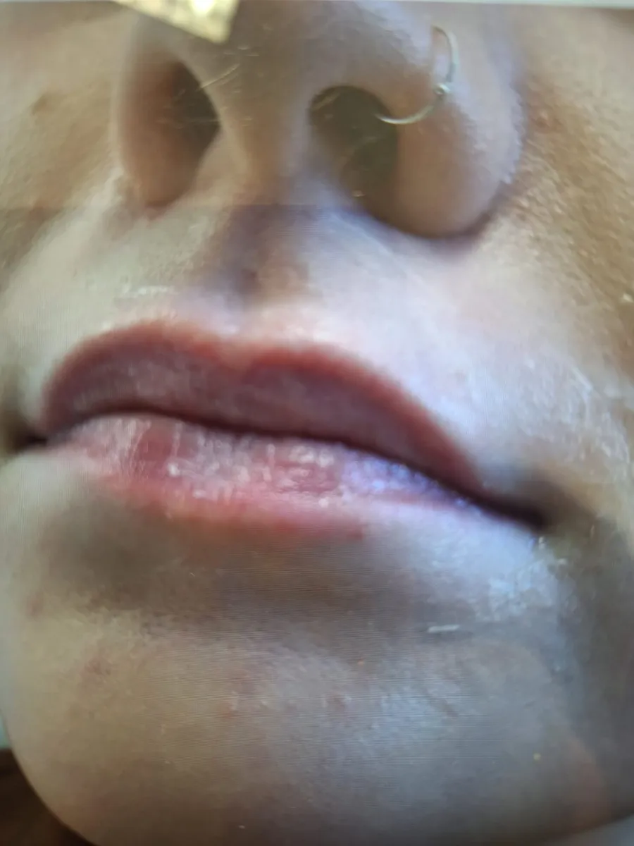 Lips before lip filler at Laserlite Aesthetic Clinic Lips before lip filler at Laserlite Aesthetic Clinic
