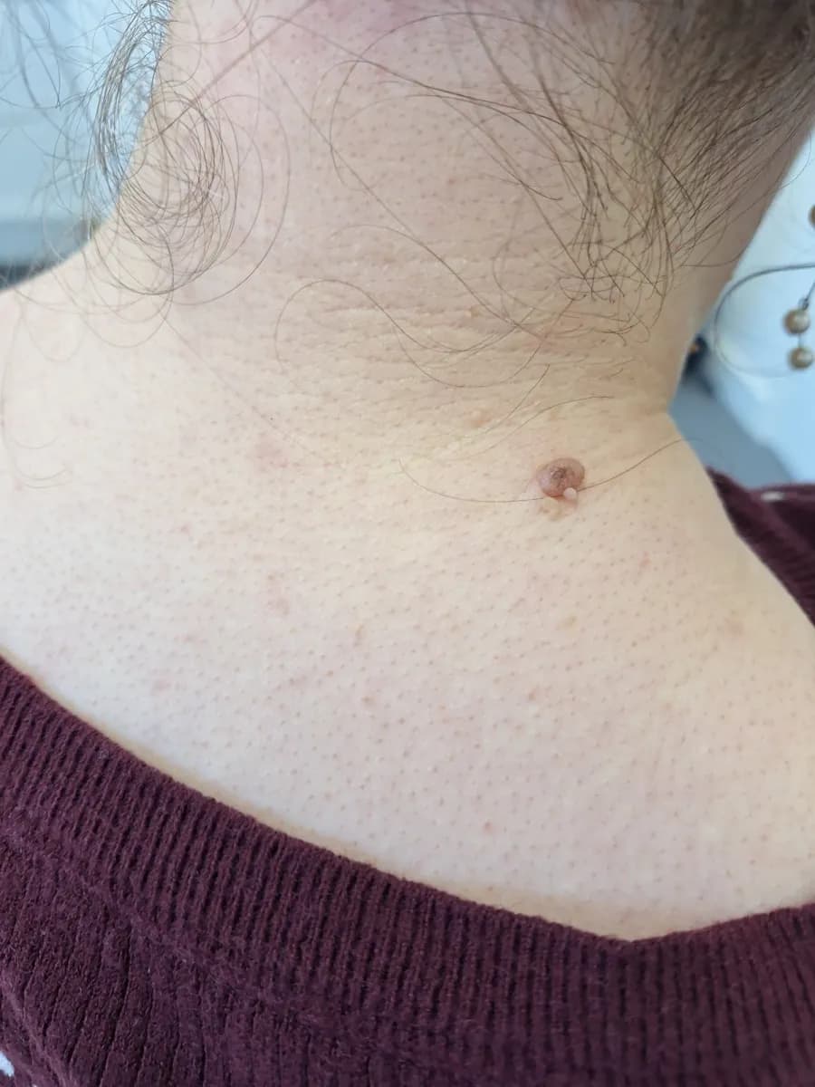 The neck after skin tag removal at Laserlite Aesthetic Clinic The neck after skin tag removal at Laserlite Aesthetic Clinic