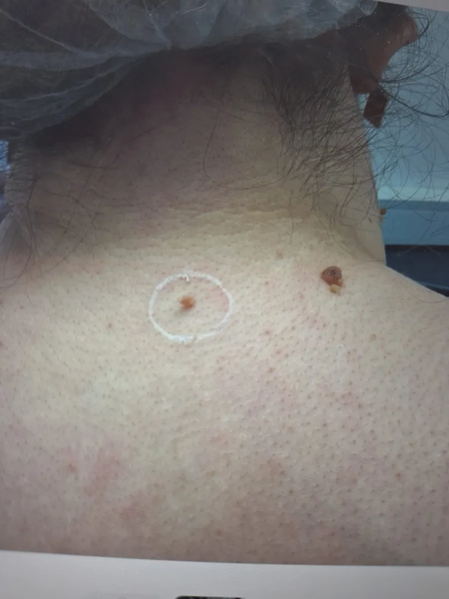 Skin tags marked up before removal at Laserlite Aesthetic Clinic Skin tags marked up before removal at Laserlite Aesthetic Clinic