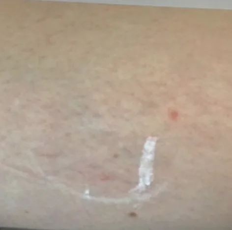 The same area after sclerotherapy at Laserlite Aesthetic Clinic The same area after sclerotherapy at Laserlite Aesthetic Clinic