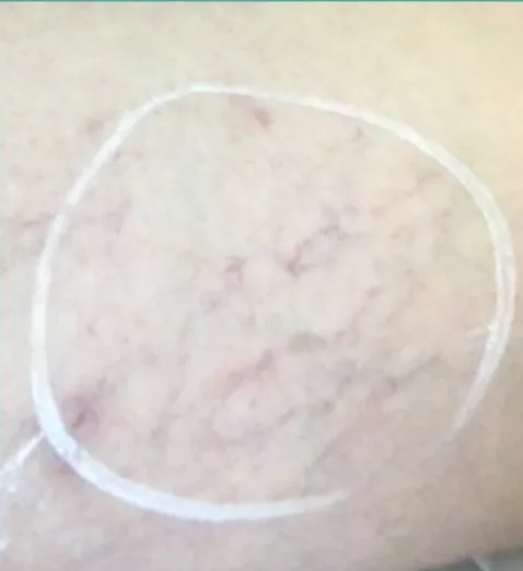 Thread veins on the leg before sclerotherapy at Laserlite Aesthetic Clinic Thread veins on the leg before sclerotherapy at Laserlite Aesthetic Clinic