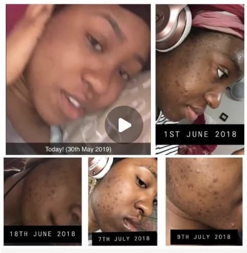 A patient’s progress photos, from 1 June 2018 to 30 May 2019, shared with their consent A patient’s progress photos, from 1 June 2018 to 30 May 2019, shared with their consent